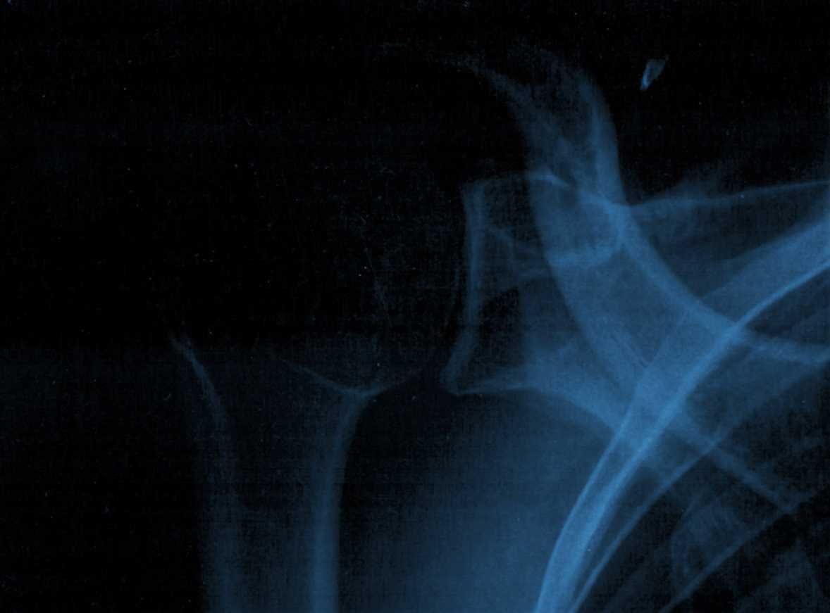 Die Abbildung zeigt einen Ausschnitt einer Röntgenaufnahme von Robert Höckmayr, auf der Metallsplitter des Oktoberfestattentats des Jahres 1980 zu erkennen sind. Die Aufnahme stammt aus Privatbesitz.